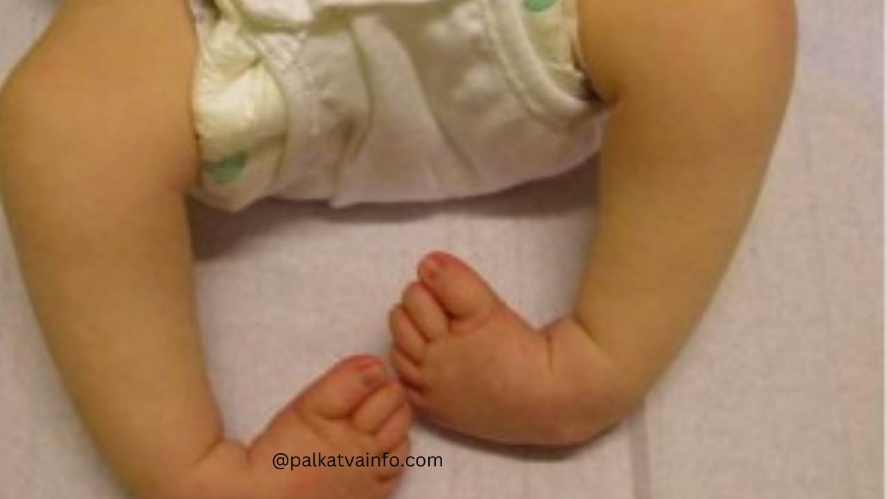 clubfeet baby in marathi